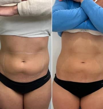 Cryolipolysis Before and After: What to Expect